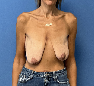Breast-Lift-with-Augmentation | Before Breast